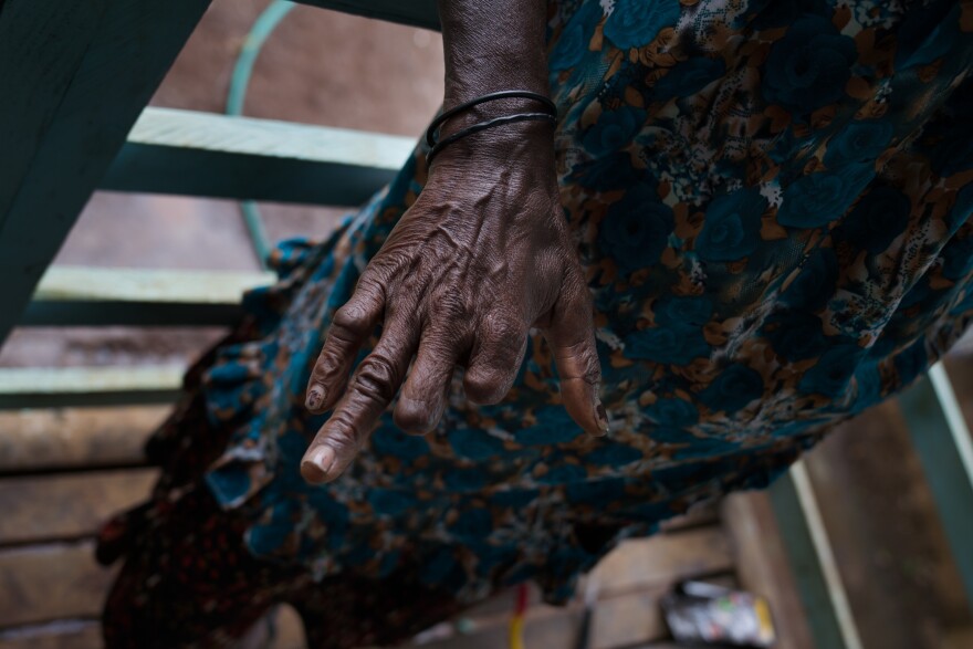 After being accused of sorcery, a woman's fingers were mutilated. Now the limited use of her hands makes it difficult to do work like laundry or sewing, so she sells betel nut on the street.