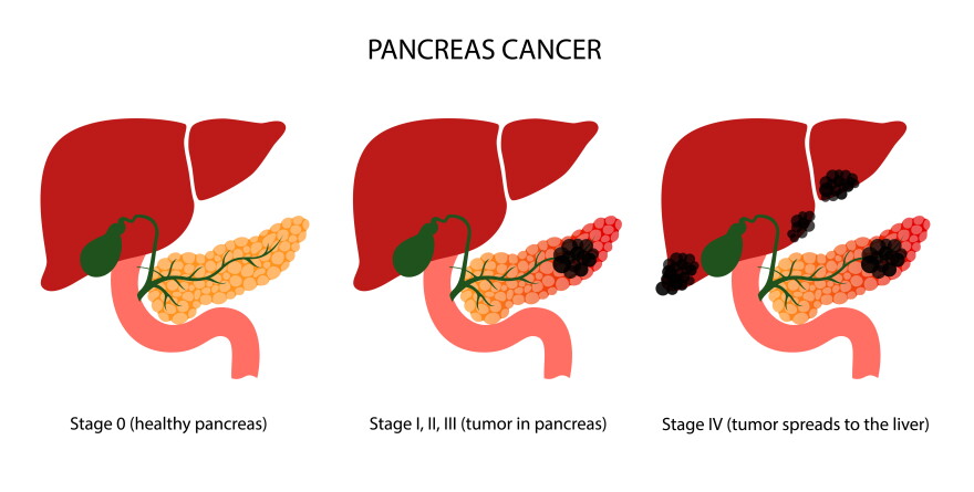 Pancreatic cancer stages, pancreas disease.