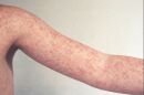 Measles is most commonly diagnosed in children and is characterized by a red spotted rash, as demonstrated in this photo.