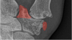 When cartilage is worn down in the thumb joint, patients experience pain and disability. Joint replacement is now an option.