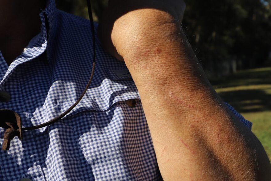 Chaparro reveals scars on his forearm from fighting with citrus tree thorns.