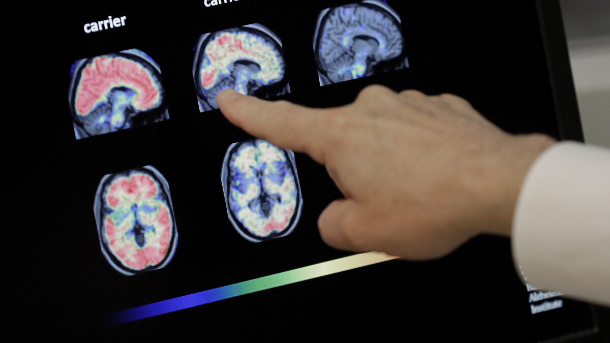 Las Vegas center's new drug trials could change future of Alzheimer's treatment - Vimarsana News