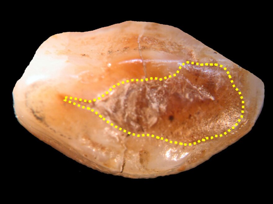 Italian researchers have discovered a 6,500-year-old tooth in Slovenia that appears to have a beeswax filling (designated by the yellow line).