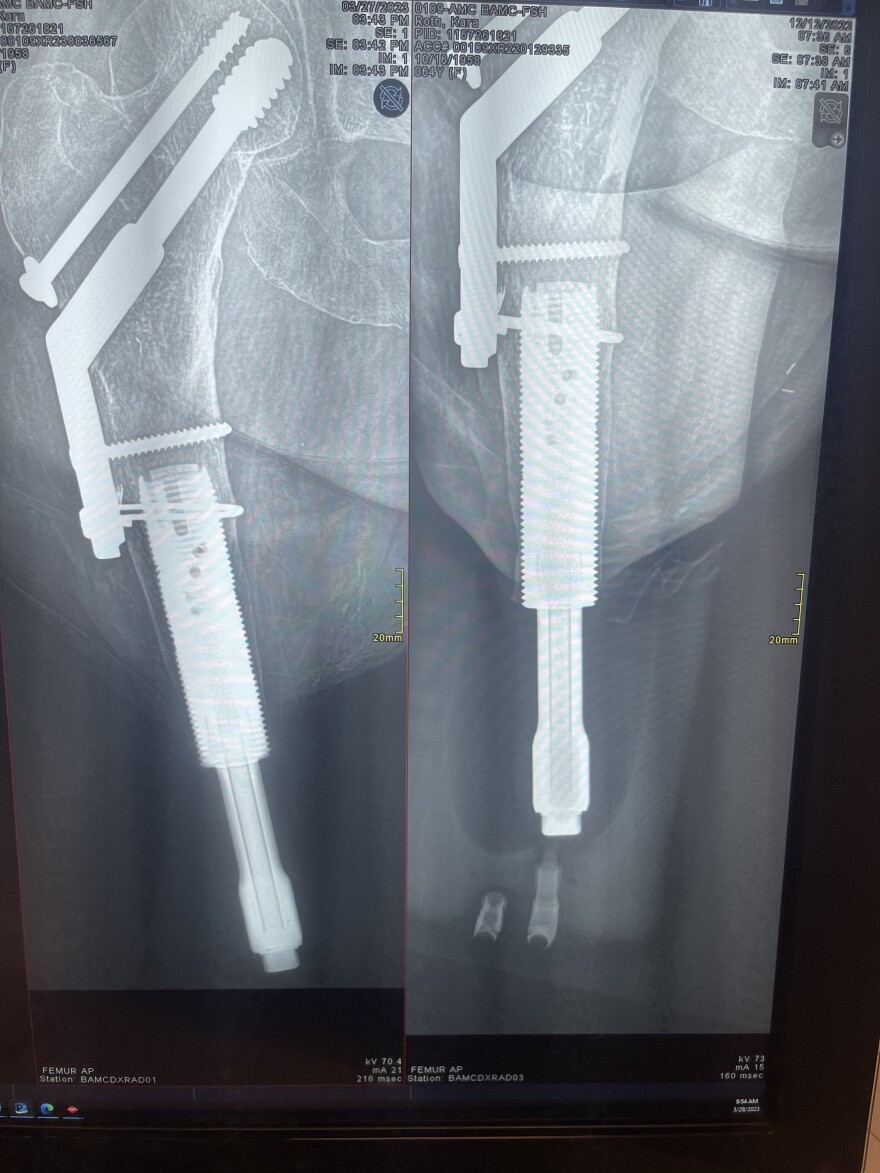 Osseointegration is a transformative surgical procedure enabling independence through a bone anchored implant.