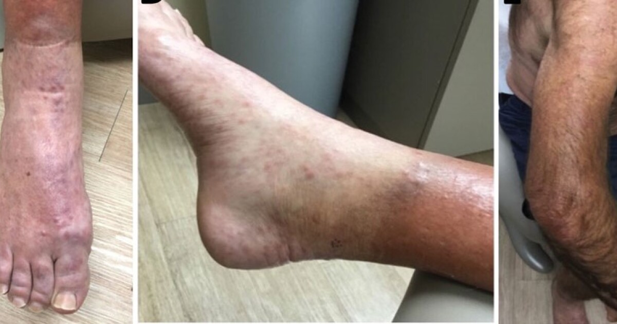 A recent increase in leprosy cases in Central Florida concerns the CDC