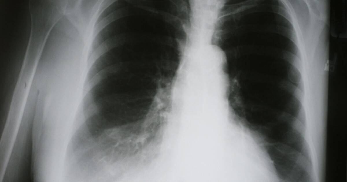 COPD One More Reason To Quit Smoking KERA News