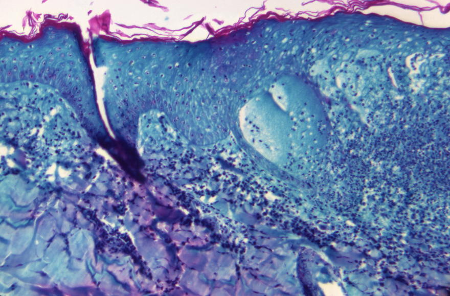 This 1968 image shows a section of skin tissue, harvested from a lesion on the skin of a monkey, that had been infected with monkeypox virus.