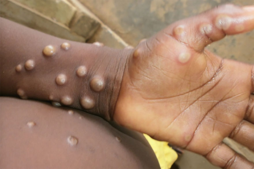Within one to three days after initial symptoms, the person develops a rash, often beginning on the face and then spreading to other parts of the body.