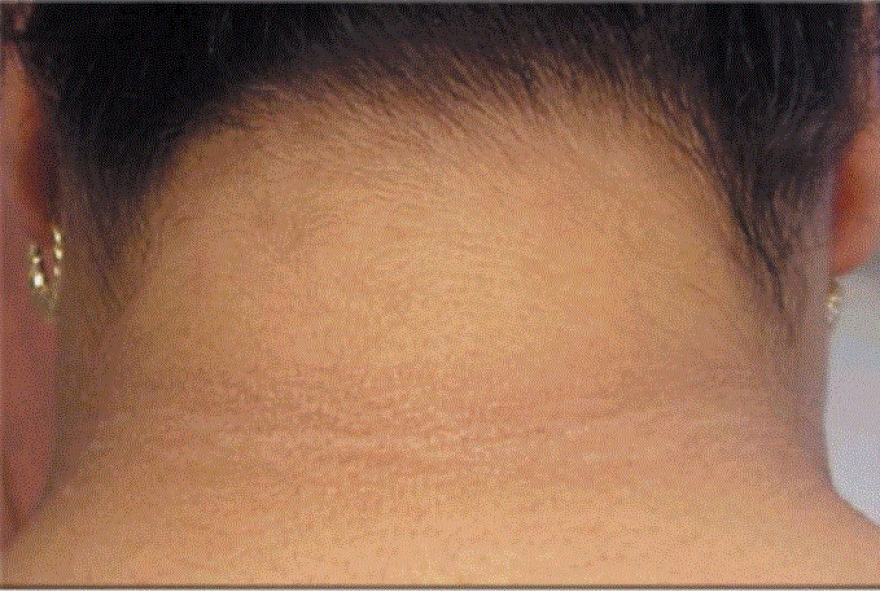  acanthosis nigricans is the darkening of the back of the neck and can be an indicator of risk for type-2 diabetes.