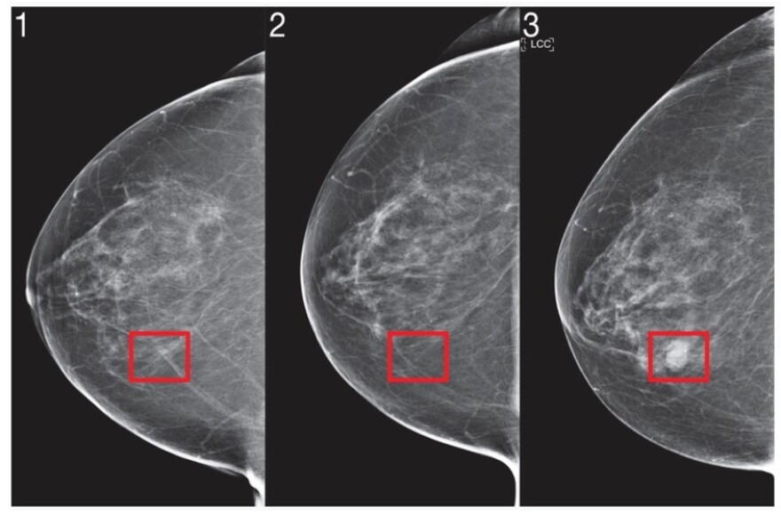  MIT researchers use artificial intelligence to predict breast cancer. 