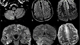 A 60-year-old-man without a history of seizures presents with convulsion after having contracted COVID-19. 