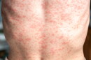 This stock image shows a person's torso covered in a measles rash.