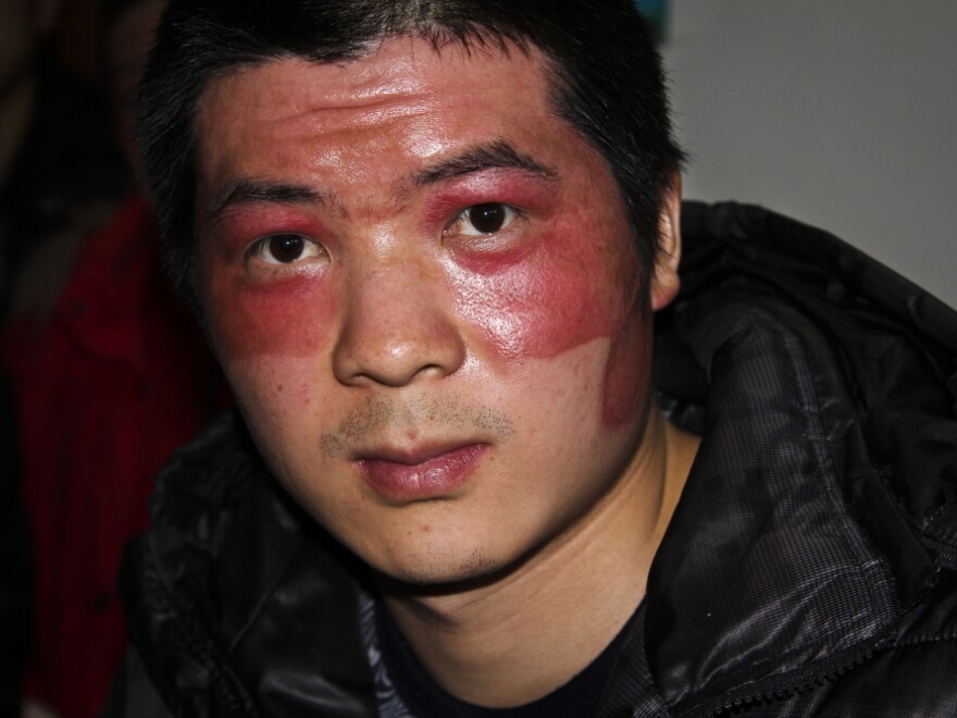 Worker He Wenwen's face was disfigured by a fireball during the December explosion at a plant that produced aluminum backings for Apple's iPad 2.