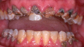 A meth mouth case.