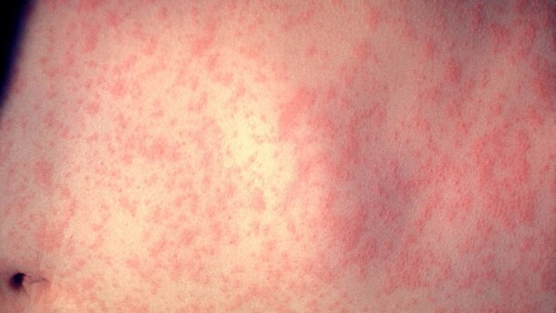 The skin of a patient after 3 days of measles infection.