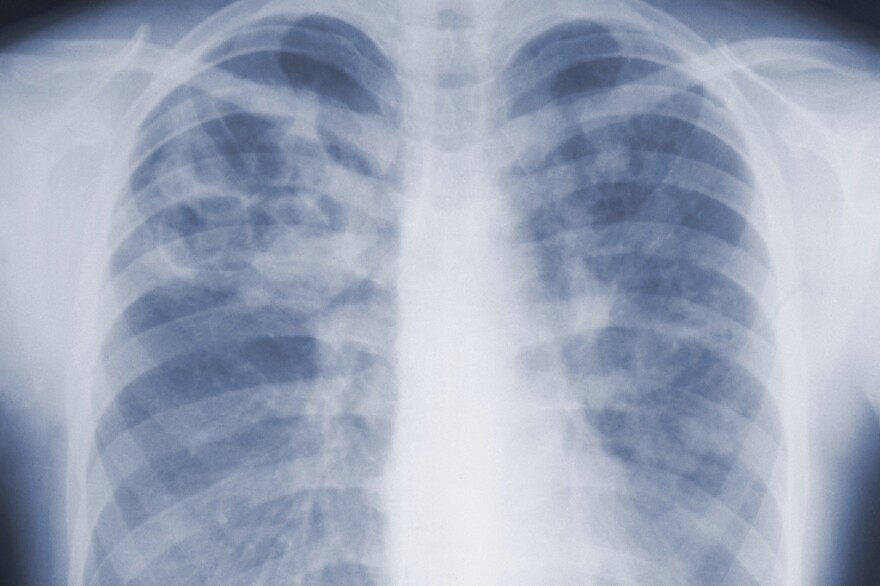 Chest x-ray photo showing ribs