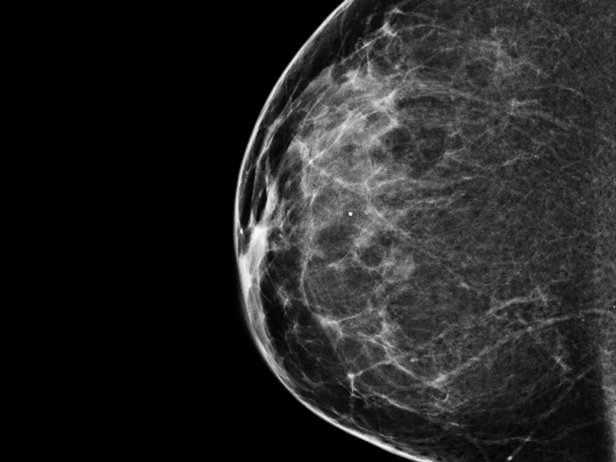 When You Need A Mammogram, Should You Get One In '3-D'? | Jefferson ...