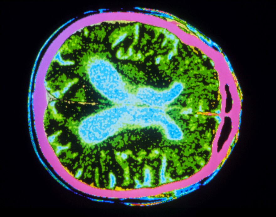 A study finds some evidence that a cancer drug, nilotinib, may help people with Parkinson's disease, a nervous system disorder that causes movement problems. It possibly works by raising levels of dopamine, the brain chemical that is lacking in people with the disease.
