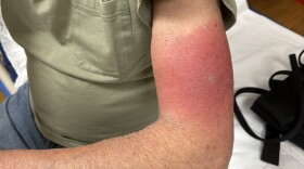 An example of a skin rash developing around a tick bite. 