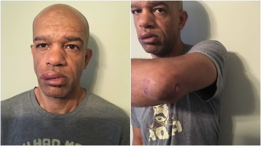 Photos released as part of trial proceedings show Luther Hall's injuries after the arrest on Sept. 17, 2017.