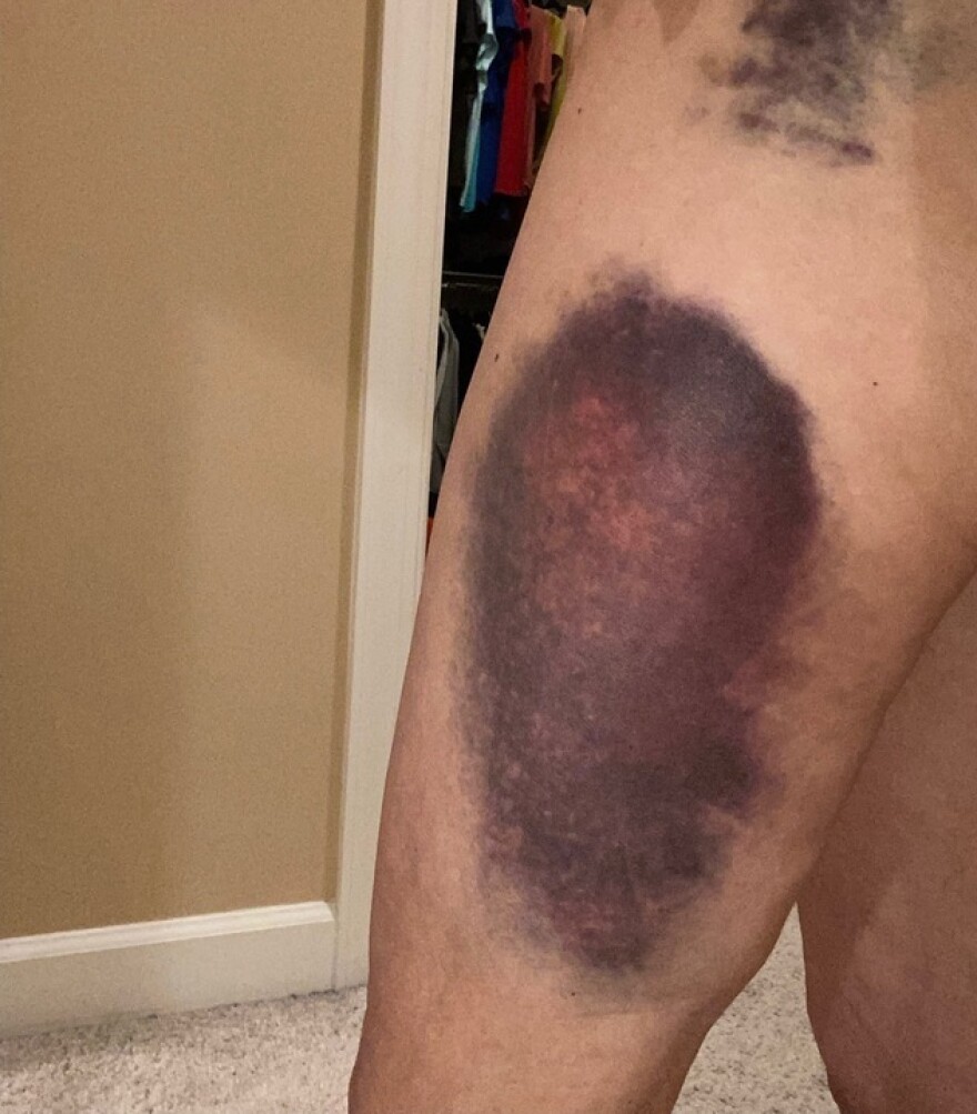 The bruise that consumed most of Aileen Sweren’s leg after she fell on pickleball stored in her pocket. (courtesy Aileen Sweren)