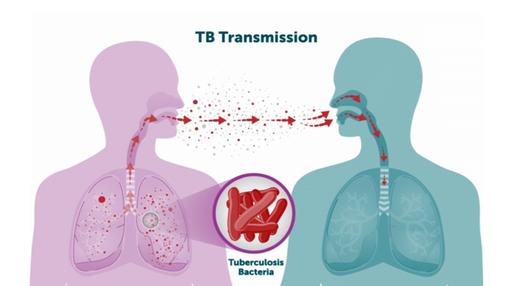 Tuberculosis case confirmed in Western North Carolina