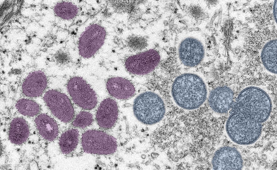 An electron microscopic image of mpox virus particles. 