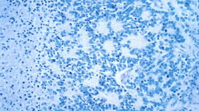  This December 1993 microscope photo provided by the National Cancer Institute shows a typical neuroblastoma with rosette formation. In a study published Wednesday, April 5, 2023, in the New England Journal of Medicine, a novel treatment, CAR-T cell therapy, using supercharged immune cells, appears to work against tumors in children with the rare kind of cancer. 
