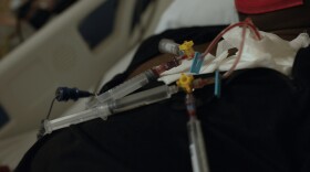 Sickle cell disease patients undergo regular exchange blood transfusions to help reduce the risk of pain crises. Every few weeks, the patients sickled blood cells are replaced with healthy blood in a process that takes anywhere from two to six hours.