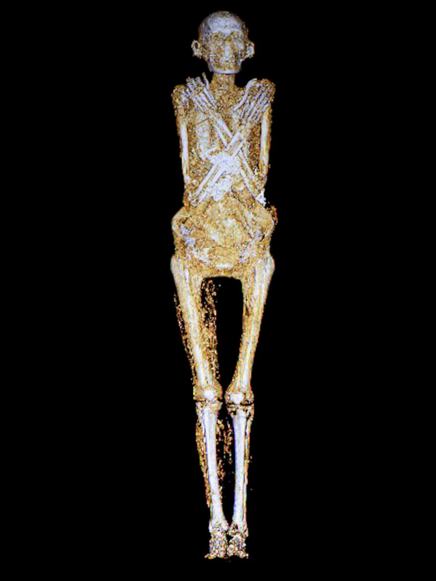 The remains of a man who lived more than two millennia ago show some of the bad effects of inactivity and poor diet.