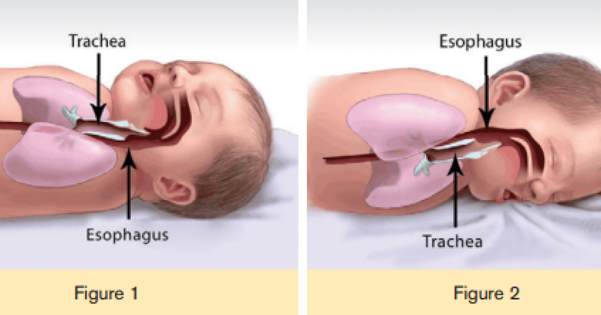 Preventable Infant Deaths On The Rise In Bexar County | TPR