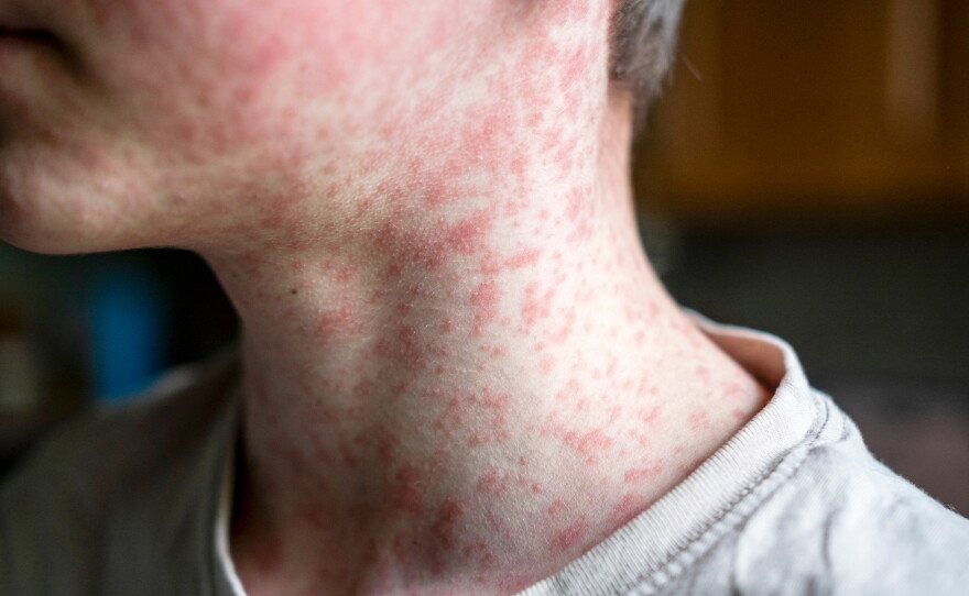 This stock image shows a person with measles.