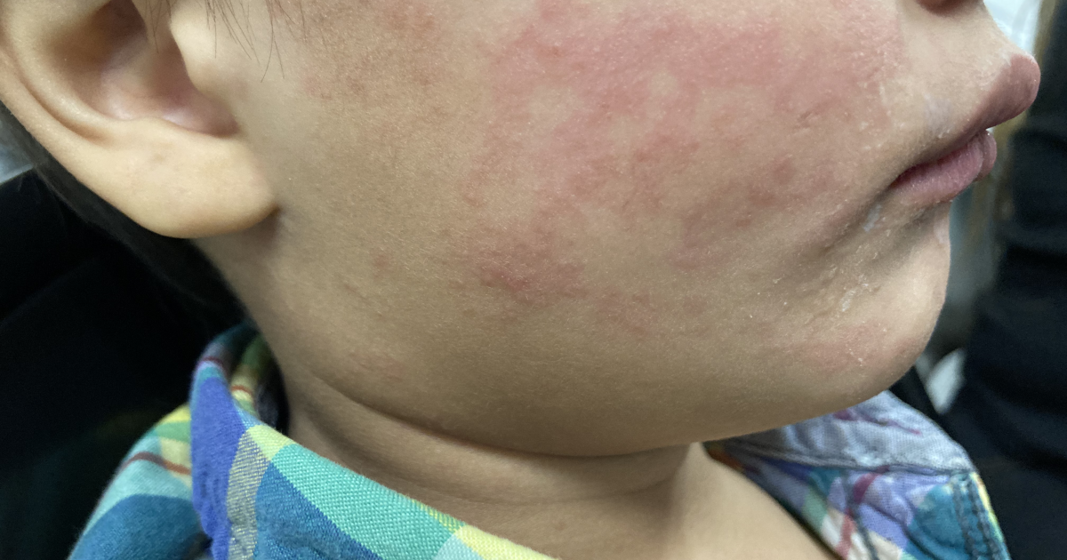 New York declares state of emergency amid measles outbreak