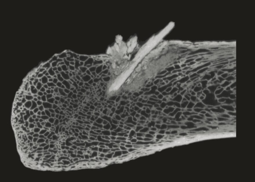 A CT scan of the bone point fragments embedded in the rib.