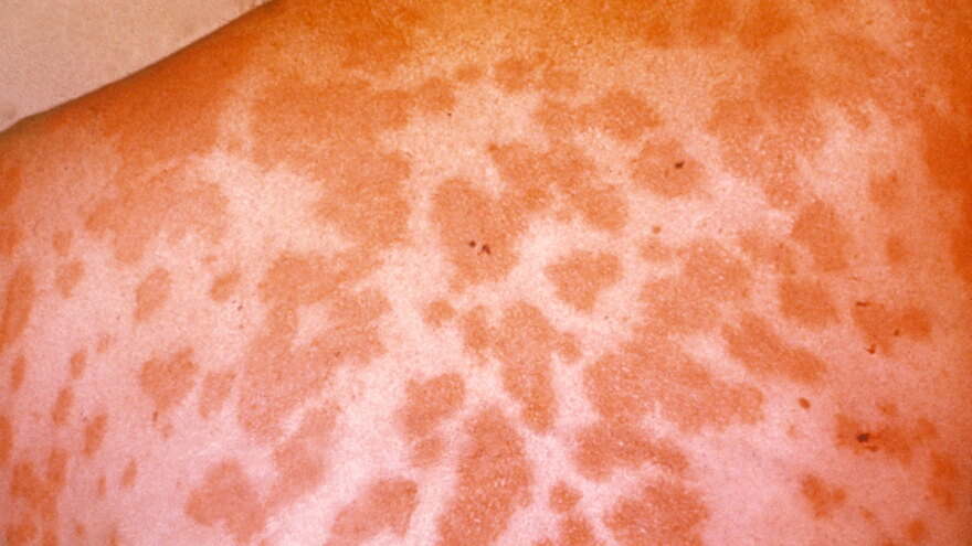 cdc valley fever rash