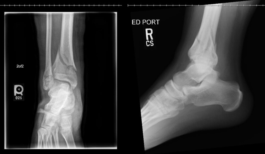 Nathan Alvarez's x-rays