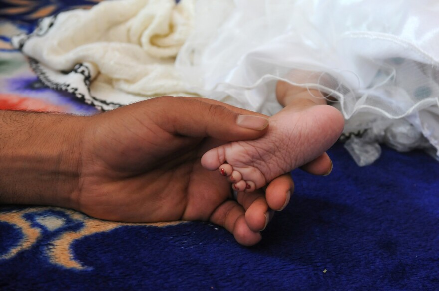 A malnourished child receives medical treatment in Sanaa, Yemen.