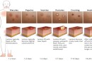 Mpox stages