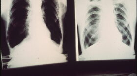 X-rays of a patient with black lung disease.