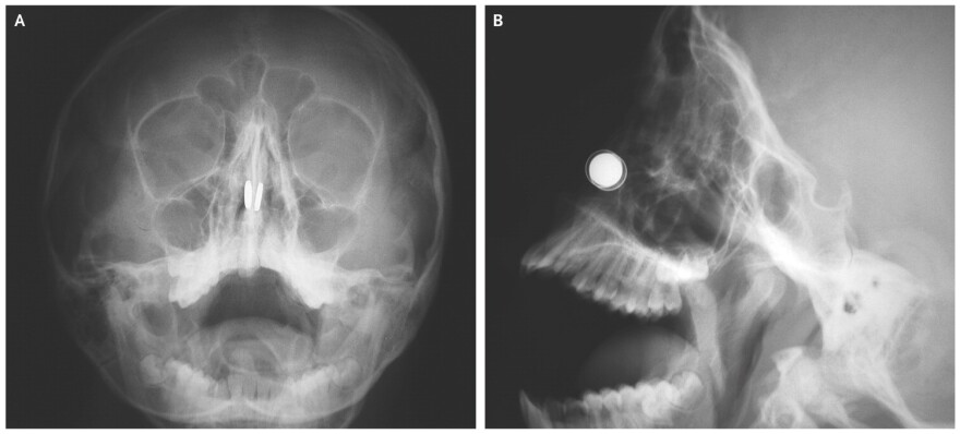 An 11-year-old boy put small magnets up both nostrils, then couldn't figure out how to get them out. These X-rays tell the tale.