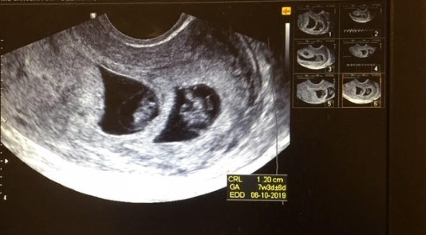 A photo of an ultrasound