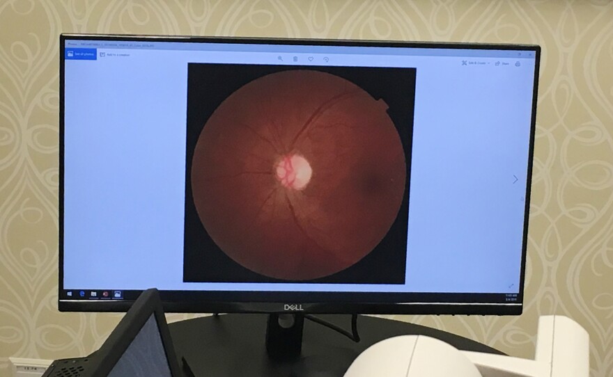 A retinal scan is displayed at University Medical Center in New Orleans using software detects is called diabetic retinopathy.