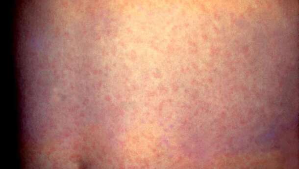 Measles ofen shows up as a rash, but has many more ill effects.