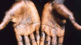 The palms of a patient with mpox during an outbreak in the Democratic Republic of Congo in 1997. The country is now seeing a dramatic spike in mpox — with a strain that is deadlier than the one that sparked the global outbreak in 2022.