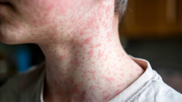 This stock image shows a person with measles.