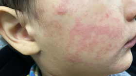 The child’s cheek shows the characteristic rash associated with measles.