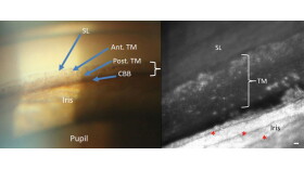 The left image shows what can usually be seen in a doctor's office. The right image shows a portion of the same part of the eye in much greater detail using methods developed at IU. (Courtesy the Indiana University School of Optometry)
