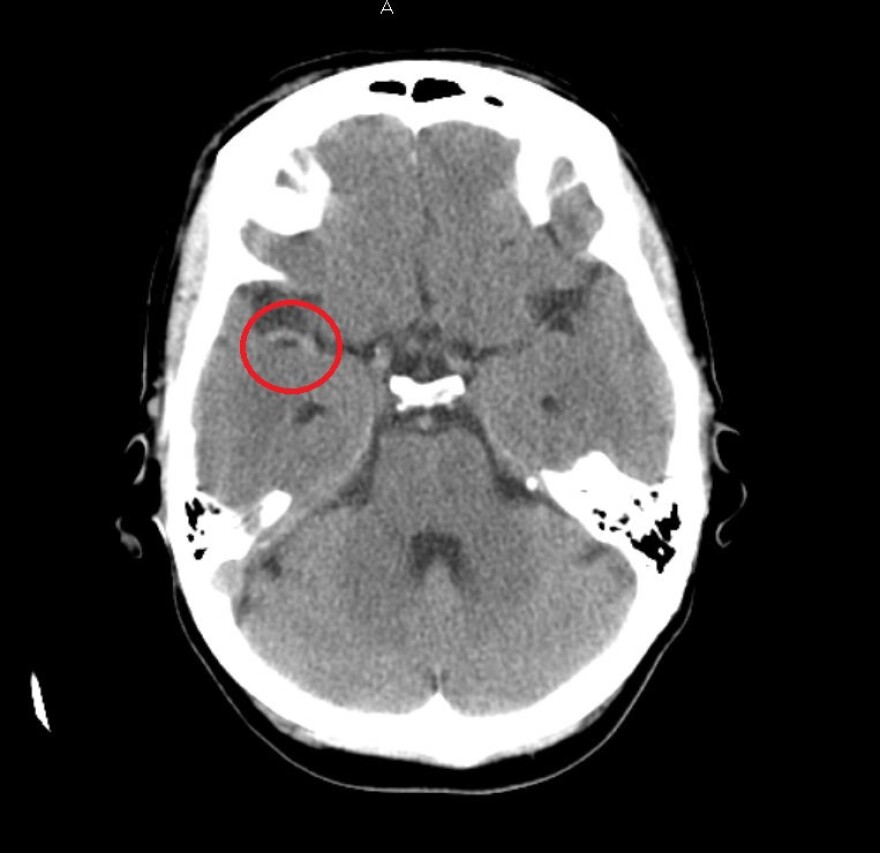 CT scan of a brain