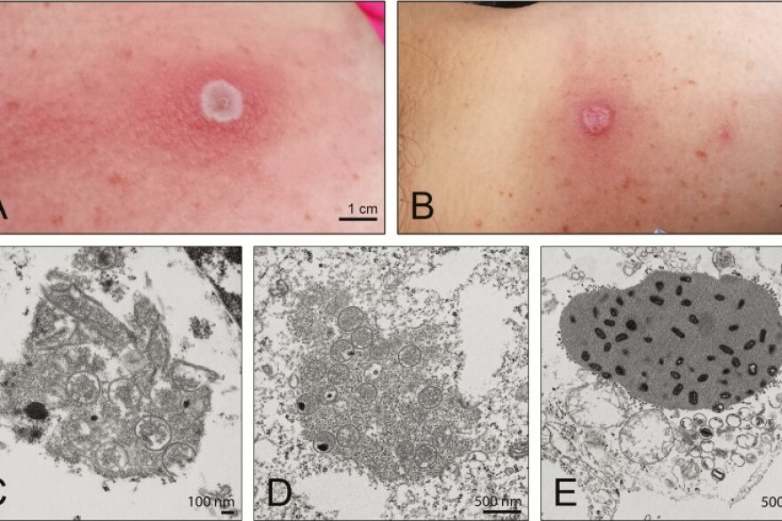 Images from 2017 article "Novel Orthopoxvirus Infection in an Alaska Resident." The virus is also referred to as "Alaskapox." Images A and B show the patient’s lesion in 2015. Images C–E show electron microscopic images of the virus isolated from the patient. (Creative Commons)