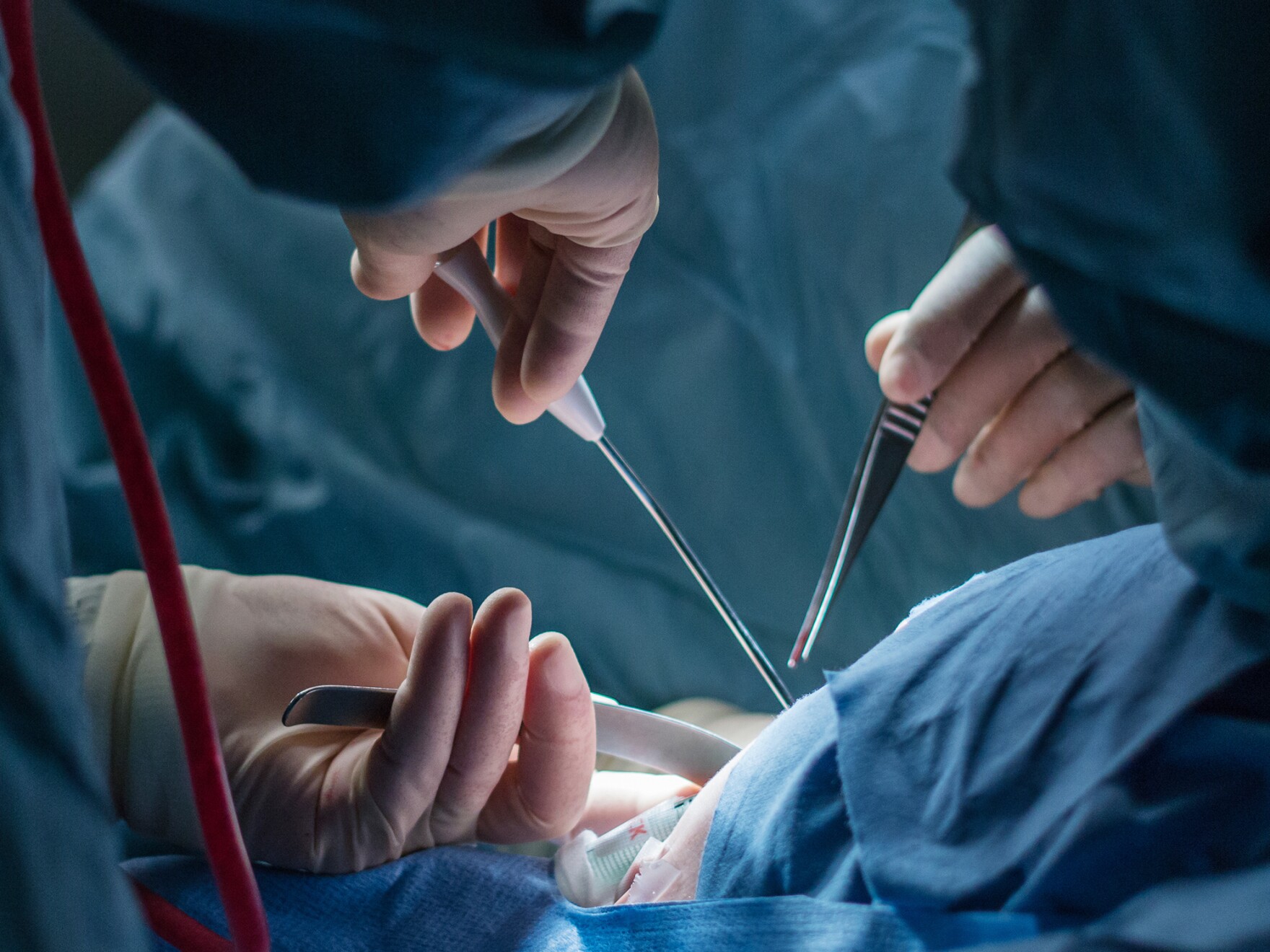 A change in guidelines for breast cancer surgery has resulted in fewer women having to undergo repeat surgeries.